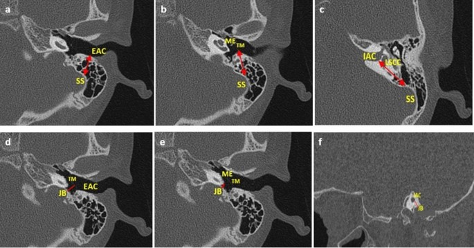 Influence of pneumatization on morphology of temporal bone ... - Nature.com