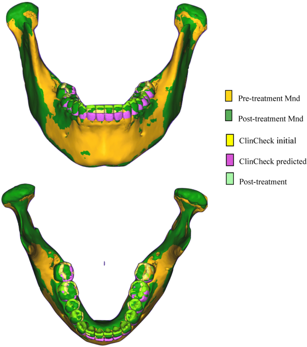 A new method assessing predicted and achieved mandibular tooth