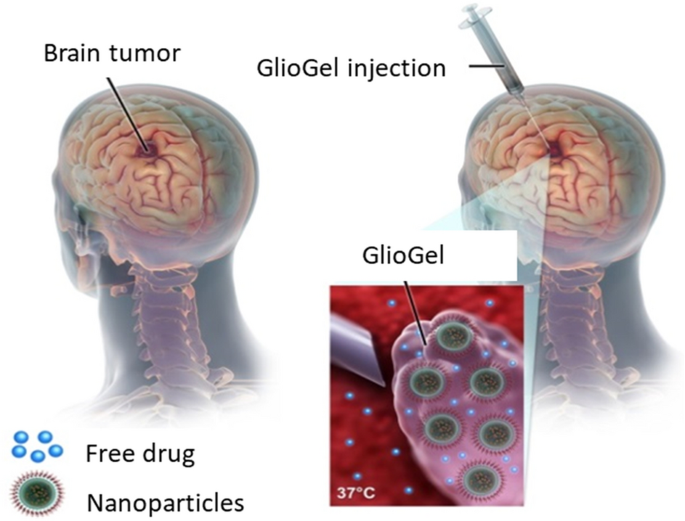glutathione injections for glioblastoma Nanocomposite formulation for a sustained release of free drug and  drug-loaded responsive nanoparticles: an approach for a local therapy of  glioblastoma multiforme