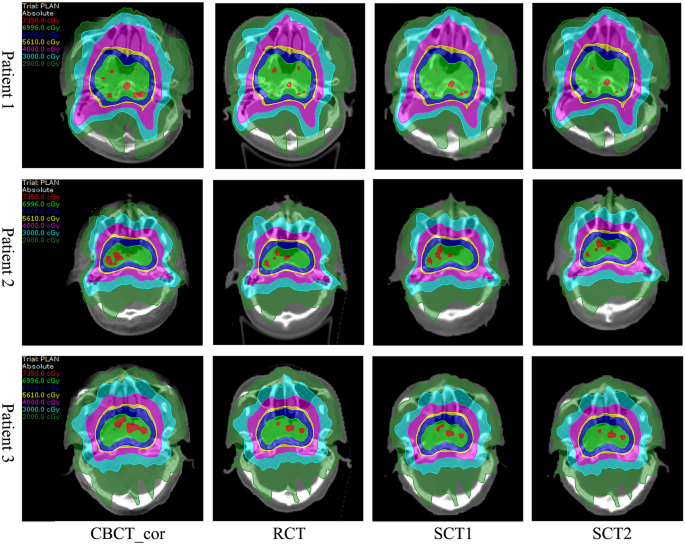 Synthetic CT generation from cone-beam CT using deep-learning for breast  adaptive radiotherapy - ScienceDirect