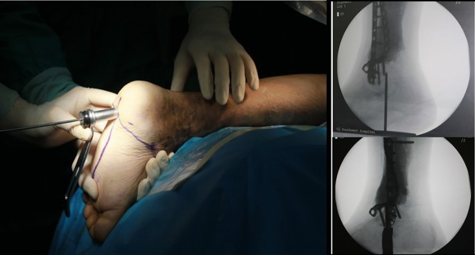 Outcome of one-stage correction of deformities of the ankle and hindfoot  and fusion in Charcot neuroarthropathy using a retrograde intramedullary  hindfoot arthrodesis nail | Bone & Joint