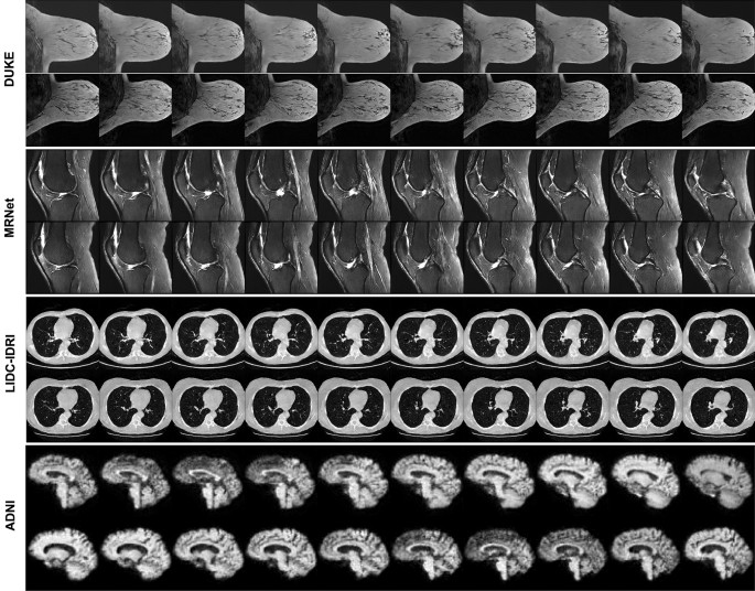 Denoising diffusion probabilistic models for 3D medical image 