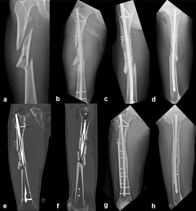 Cureus | Femoral Neck Nonunion Associated With Delayed Union of Ipsilateral  Femoral Shaft Fracture | Article