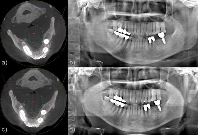 How CBCT scans can detect cancer, DentalRay posted on the topic