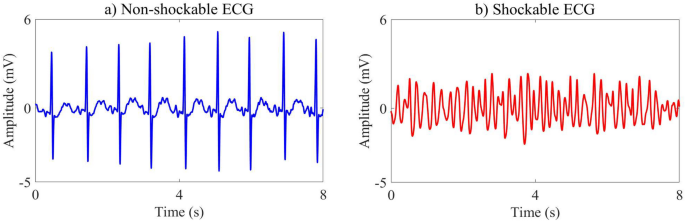 Diagnosis of sudden cardiac arrest using principal component analysis in automated external defibrillators