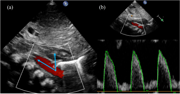 Echocardiographic assessment of brain sparing in small-for-gestational age  infants and association with neonatal outcomes
