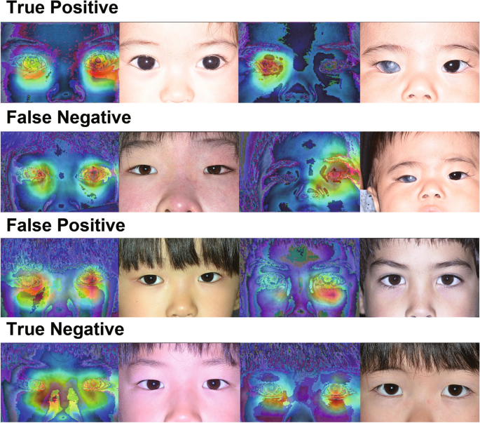 Congenital glaucoma as a presenting feature of Rubinstein-Taybi