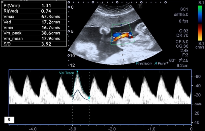 Normal umbilical artery doppler values in 18–22 week old fetuses with  single umbilical artery | Scientific Reports