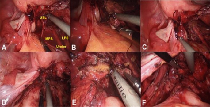 Laparoendoscopic single-site surgery for deep infiltrating