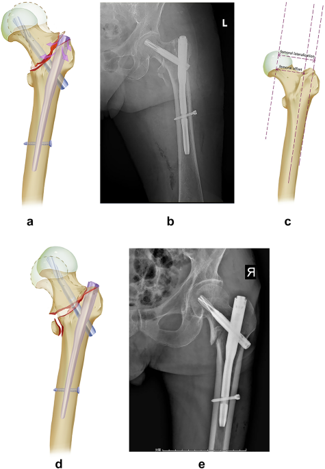 Nail insertion entry points shown for the right femur: lateral (left)... |  Download Scientific Diagram
