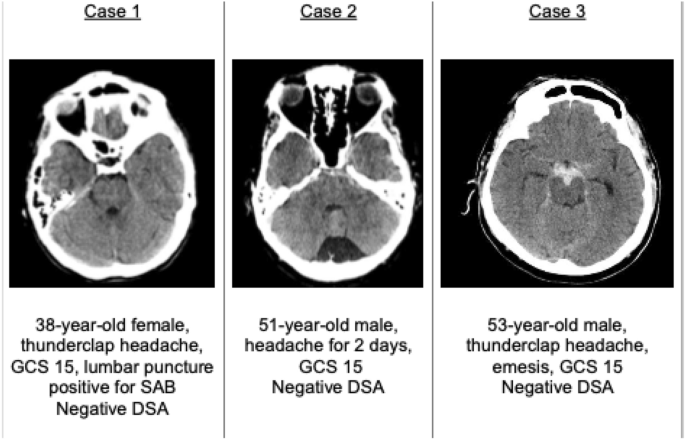 Subarachnoid Hemorrhage (SAH): Symptoms & Treatment