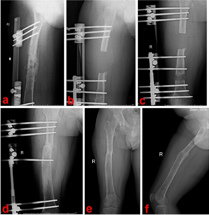 Bone Transport  International Center for Limb Lengthening