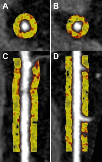 Pericoronary adipose tissue attenuation on coronary computed ... - Nature.com