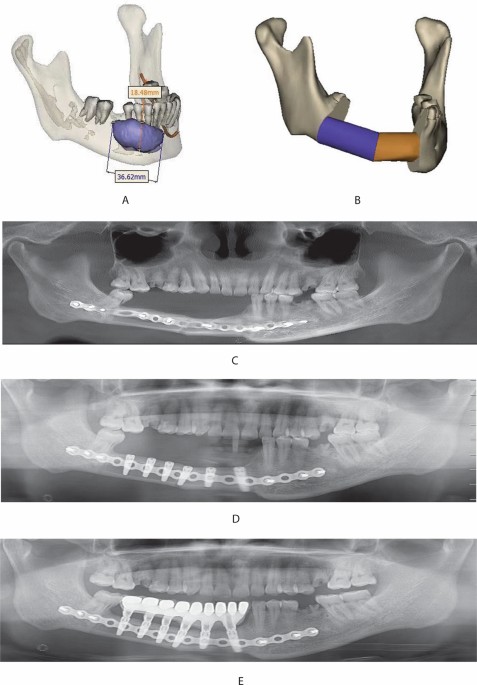 Clinical details: (a) X-ray: implant failure with subsequent plate