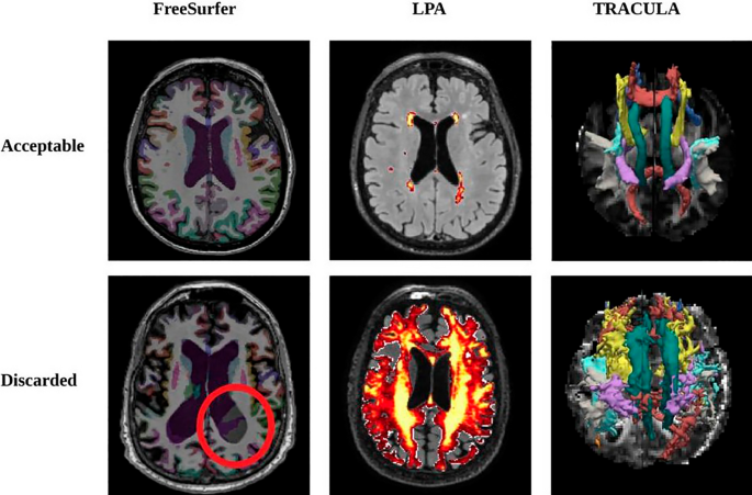 Clinical Manifestations: Alzheimer's & Dementia: Vol 19, No S4