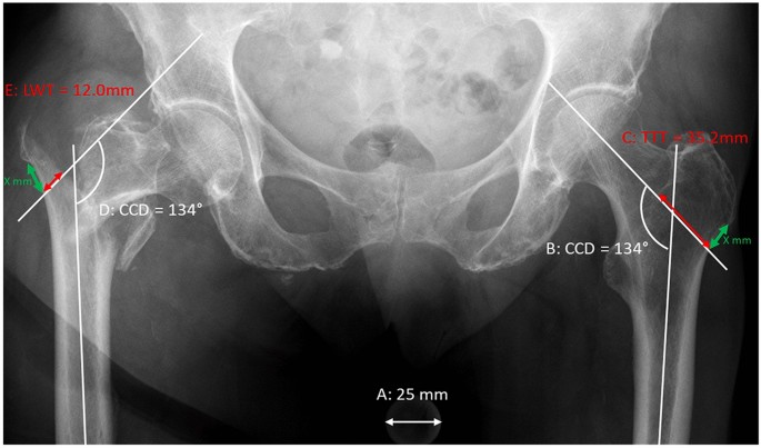 Relative lateral wall thickness is an improved predictor for 