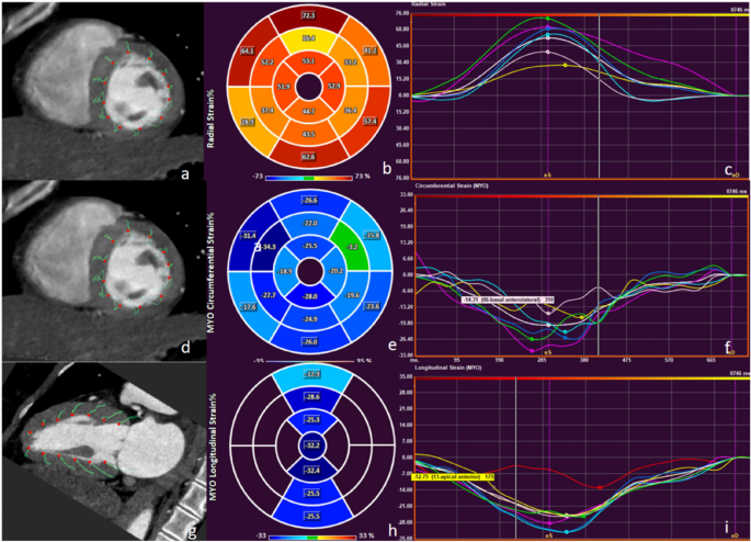 Myocardial strain assessed by feature tracking cardiac magnetic