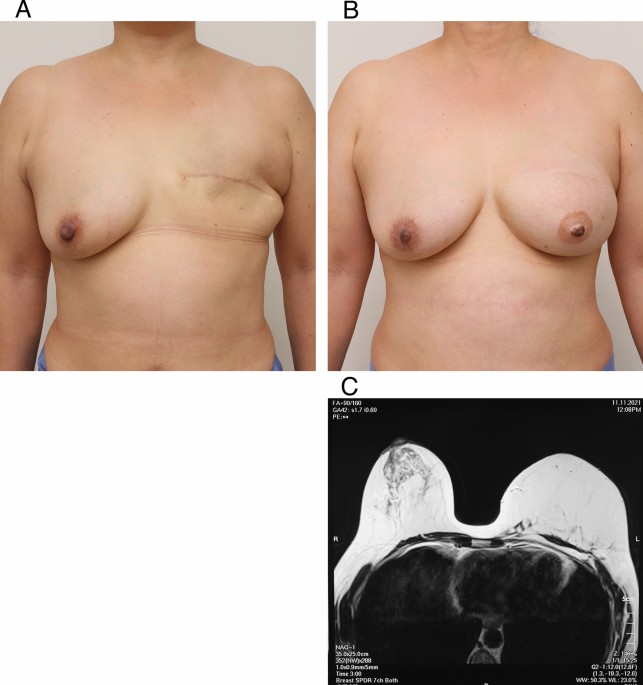 Successful fat-only whole breast reconstruction using cultured mature  adipocytes and conditioned medium containing MCP-1
