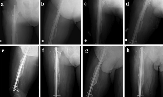 PDF) Exchange nailing with open bone grafting for aseptic femoral  diaphyseal nonunion with implant failure: A study of 13 cases | Kota Aditya  - Academia.edu