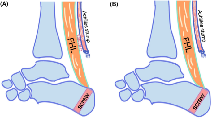 Belly Up or Down What are we missing? Prone vs. Supine MRI