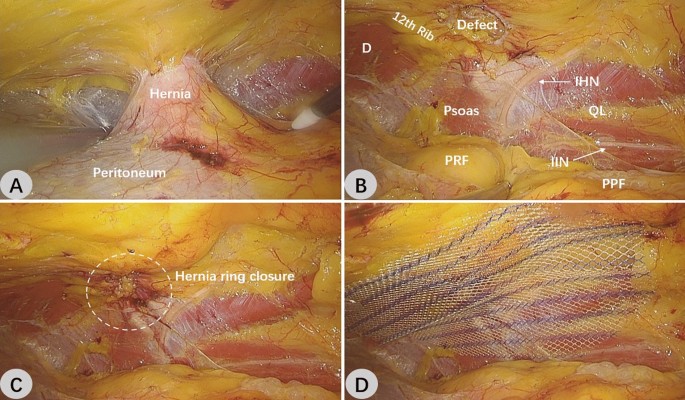 Retroperitoneal totally endoscopic prosthetic repair of lumbar hernia