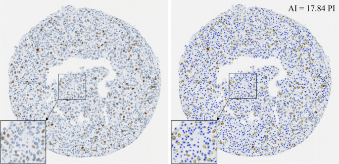 AI improves accuracy, agreement and efficiency of pathologists for Ki67 assessments in breast cancer