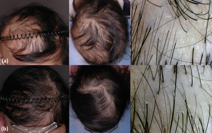 Topical minoxidil and dietary supplement for the treatment of 