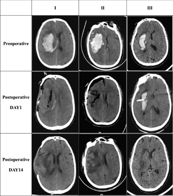 Factors associated with depression and cognitive impairment after ...