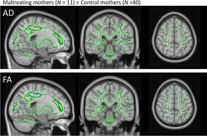 Diffusion tensor imaging of white-matter structural features of maltreating mothers and their associations with intergenerational chain of childhood a
