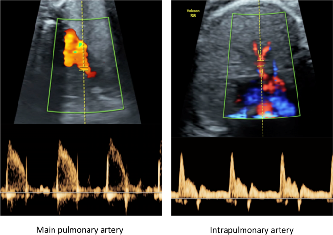 Pulmonary vascular reactivity in growth restricted fetuses using 