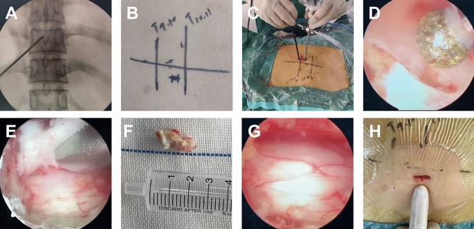 Safety and efficacy of one-hole split endoscope technique for surgical treatment of thoracic ossification of the ligamentum flavum