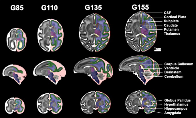 delta 9 cigarettes Prenatal delta-9-tetrahydrocannabinol exposure alters fetal  neurodevelopment in rhesus macaques