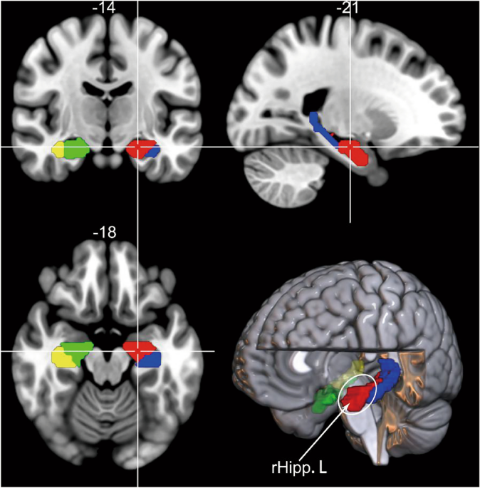 The association between gray matter volume in the hippocampal subfield and antidepressant efficacy mediated by abnormal dynamic functional connectivity