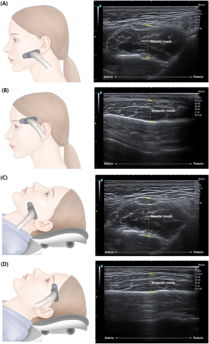 Comparison of ultrasonography-based masticatory muscle thickness between  temporomandibular disorders bruxers and temporomandibular disorders  non-bruxers | Scientific Reports
