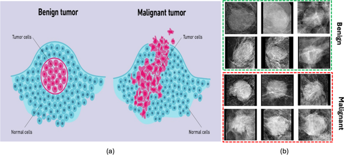 Predictive modeling for breast cancer classification in the context of Bangladeshi patients by use of machine learning approach with explainable AI