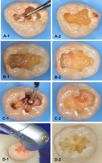 An in vitro assessment of the residual dentin after using three minimally invasive caries removal techniques