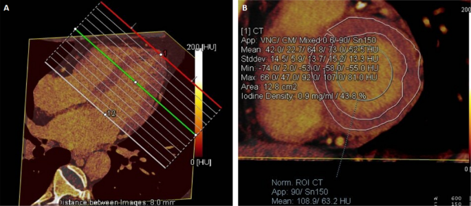 Prognostic value of measurement of myocardial extracellular volume