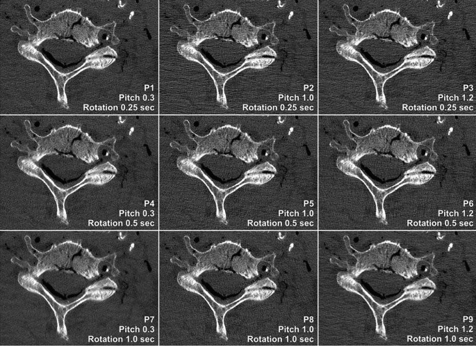 Influence of helical pitch and gantry rotation time on image 