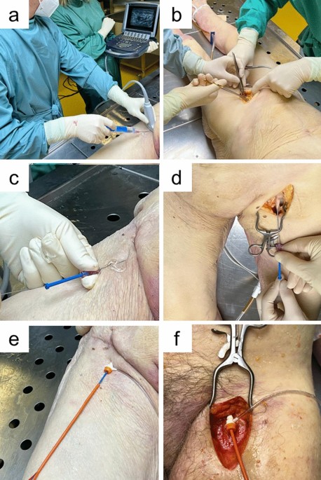 Percutaneous ultrasound-guided versus open cut-down access to femoral vessels for the placement of a reboa catheter