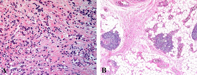 Preliminary study on the optical diagnosis of orbital rhabdomyosarcoma by raman spectroscopy