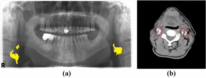 CACSNet for automatic robust classification and segmentation of carotid artery calcification on pano