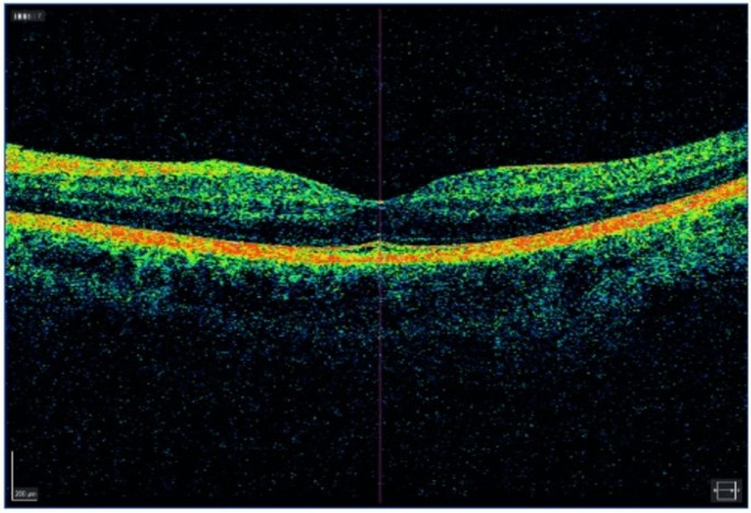 Vitrectomy versus scleral buckle for retinal detachment without ...