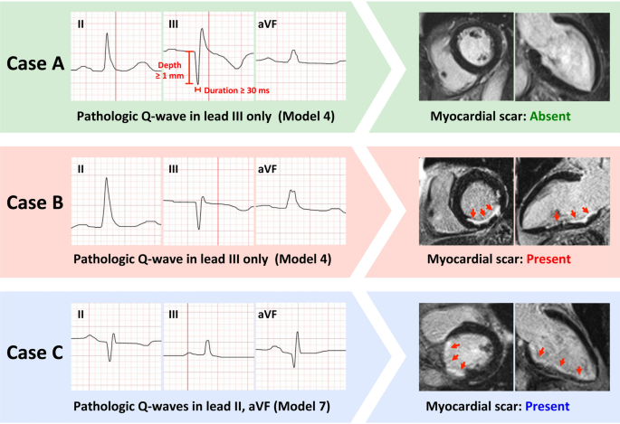 Diagnostic values of inferior Q-waves for myocardial scar identification detected by 3.0 T cardiac MRI | Scientific Reports... 