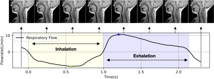 The effect of including dynamic imaging derived airway wall motion 
