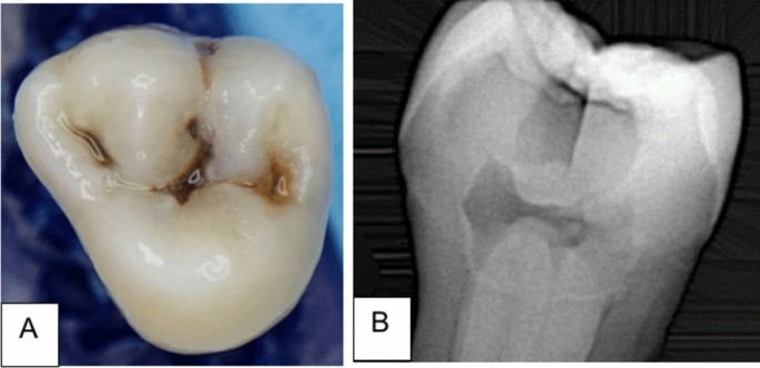 An in-vitro evaluation of residual dentin retained after using 
