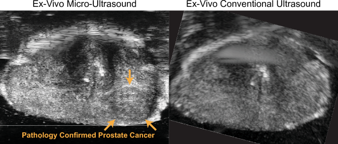 Prostate Echo Evaluation of prostate cancer detection using micro-ultrasound versus ...