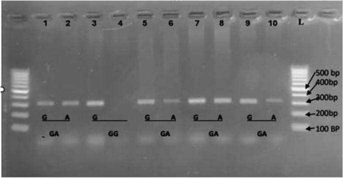 Interleukin 6 and interleukin 17A serum levels and gene- polymorphisms ...