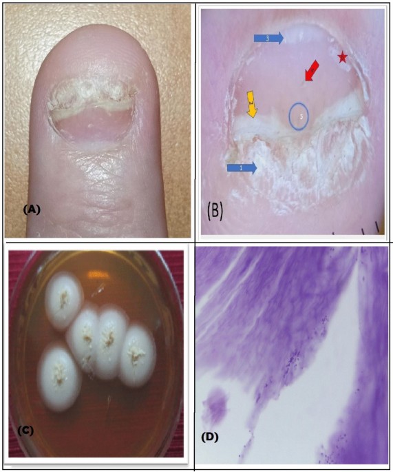 Prevalence of onychomycosis among psoriasis patients: a clinico-mycological and dermoscopic comparative cross sectional study
