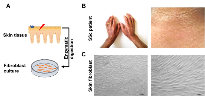 Exosomes carrying adipose mesenchymal stem cells function alleviate  scleroderma skin fibrosis by inhibiting the TGF-1/Smad3 axis | Scientific  Reports