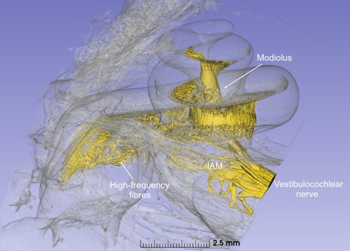 A novel therapeutic pathway to the human cochlear nerve | Scientific ...